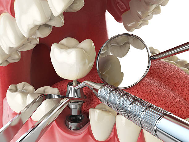 Best Emergency Root Canal Treatment in National Harbor, MD